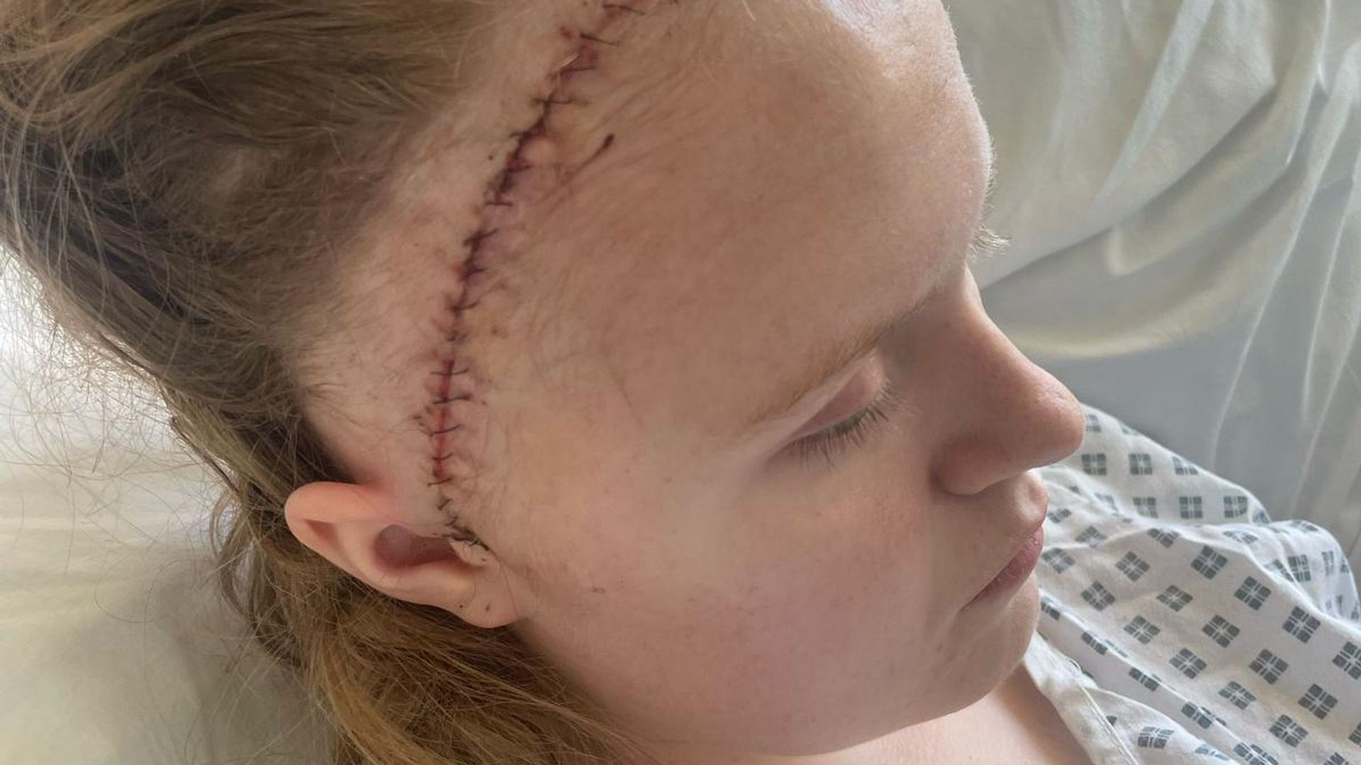 Teenager had part of skull stored in her stomach after rare brain bleed
