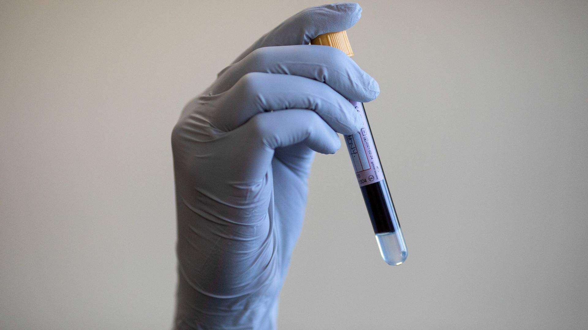 Blood test that can detect 12 common cancers to be trialled on NHS