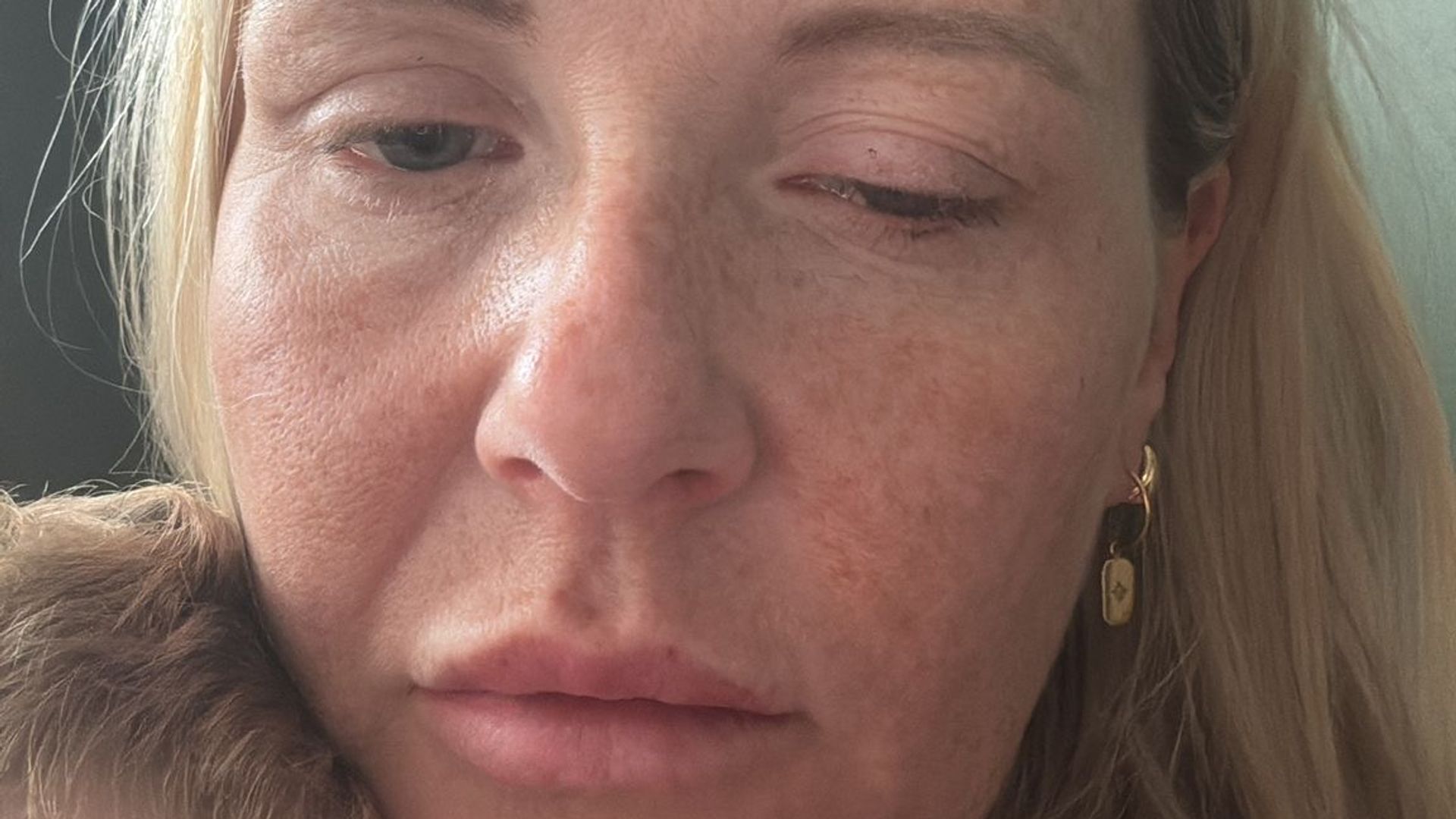 ‘It’s the Wild West’: Dozens of women develop botulism linked to anti-wrinkle injections