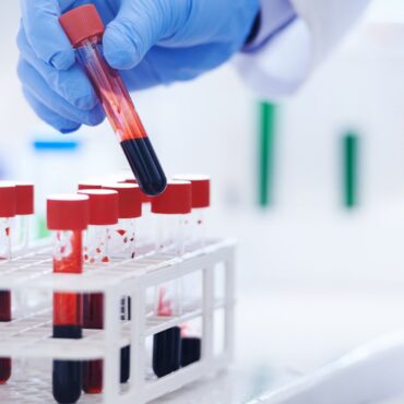 UK patients to trial blood test that could ‘revolutionise’ Alzheimer’s diagnosis