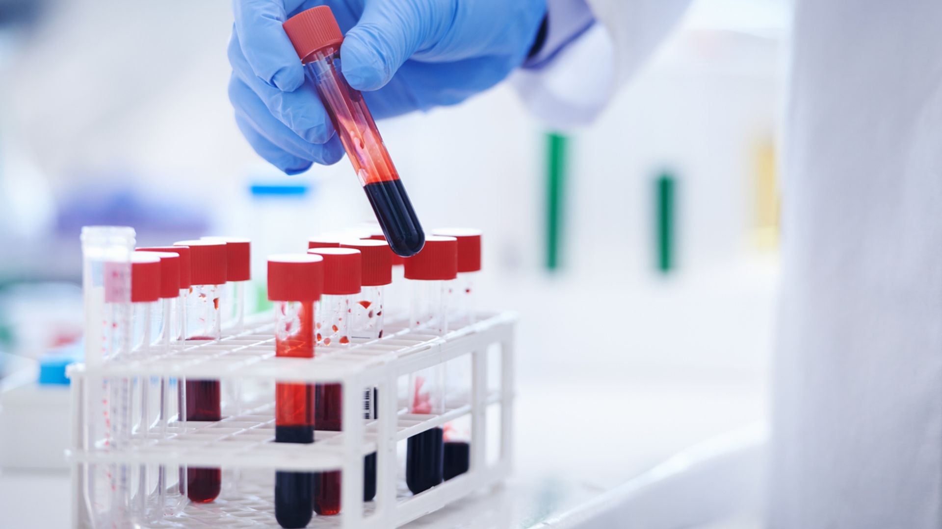 UK patients to trial blood test that could ‘revolutionise’ Alzheimer’s diagnosis