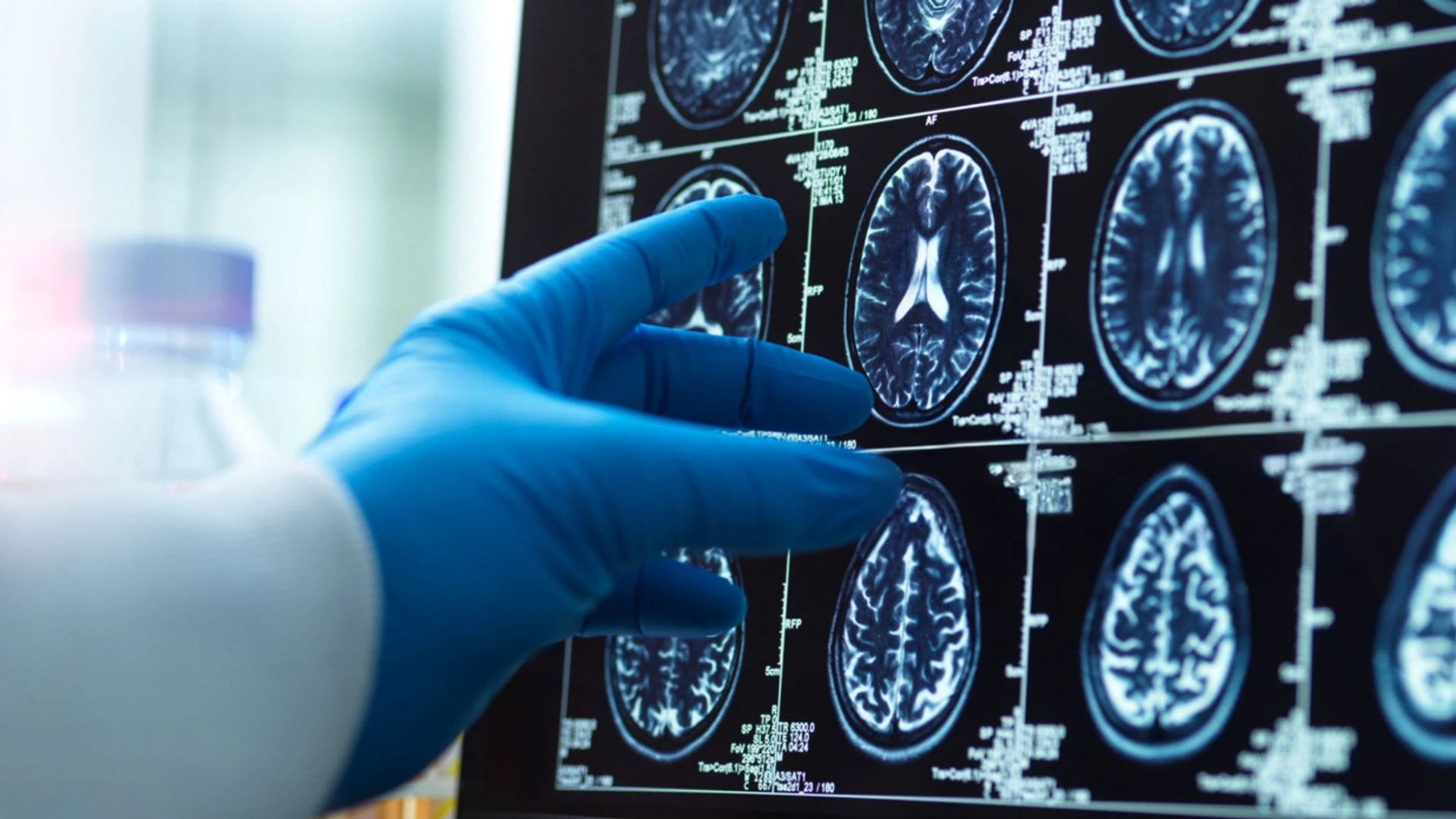 Menopause ‘triggers loss of brain matter which could explain women’s higher dementia risk’