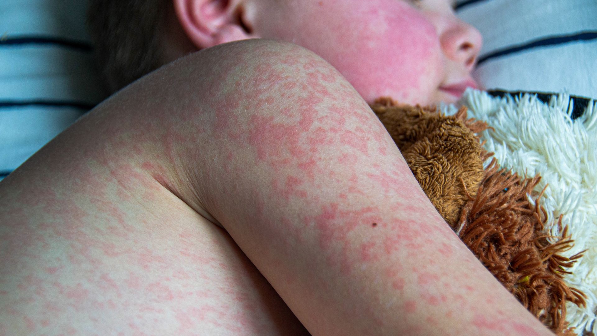 UK loses measles elimination status, warns WHO