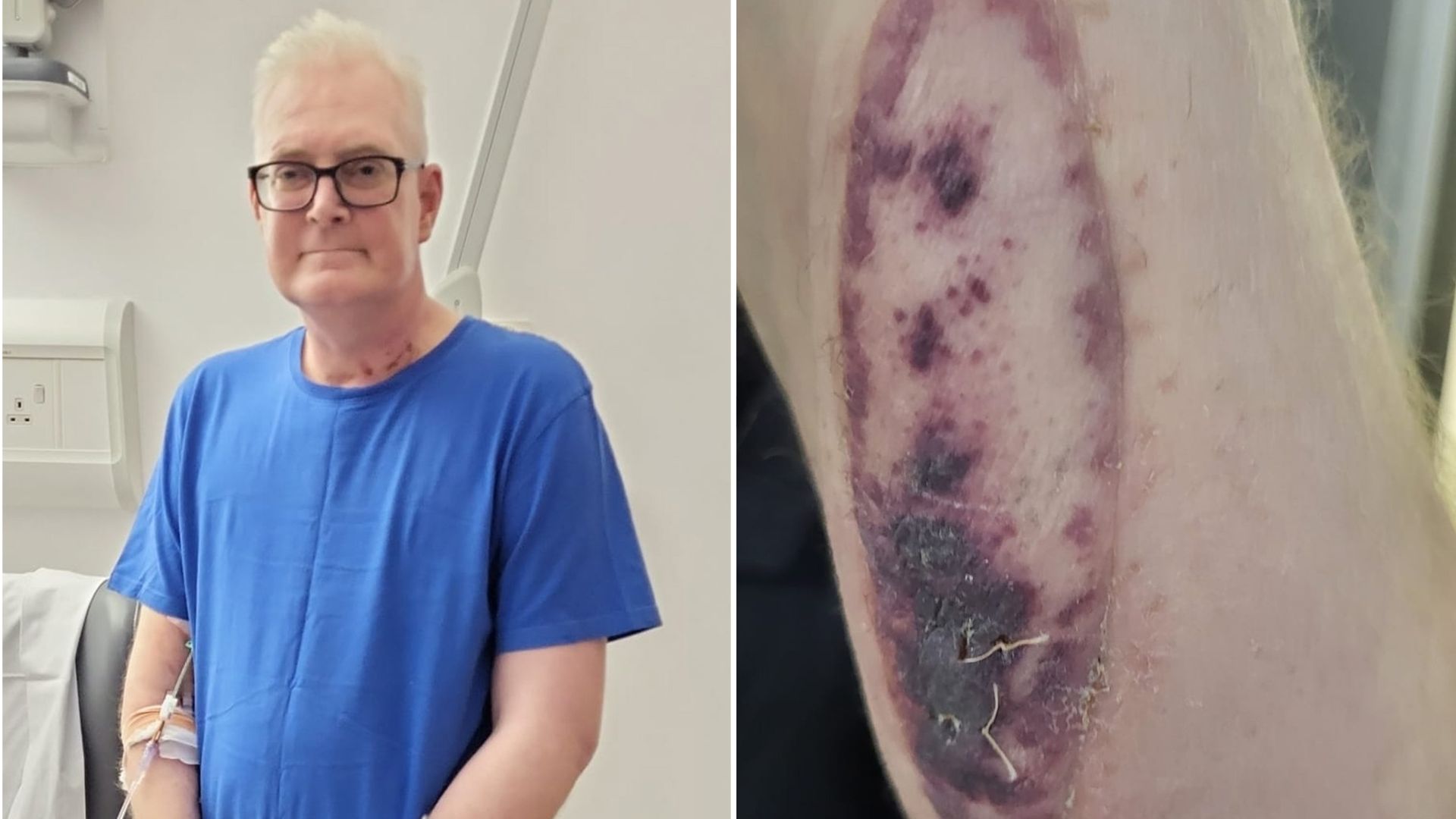 Organ donor’s skin patch helped patient discover new lung was being rejected