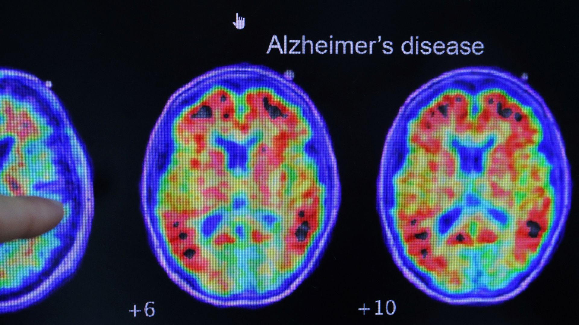 Simple at-home test can predict Alzheimer’s risk, says study
