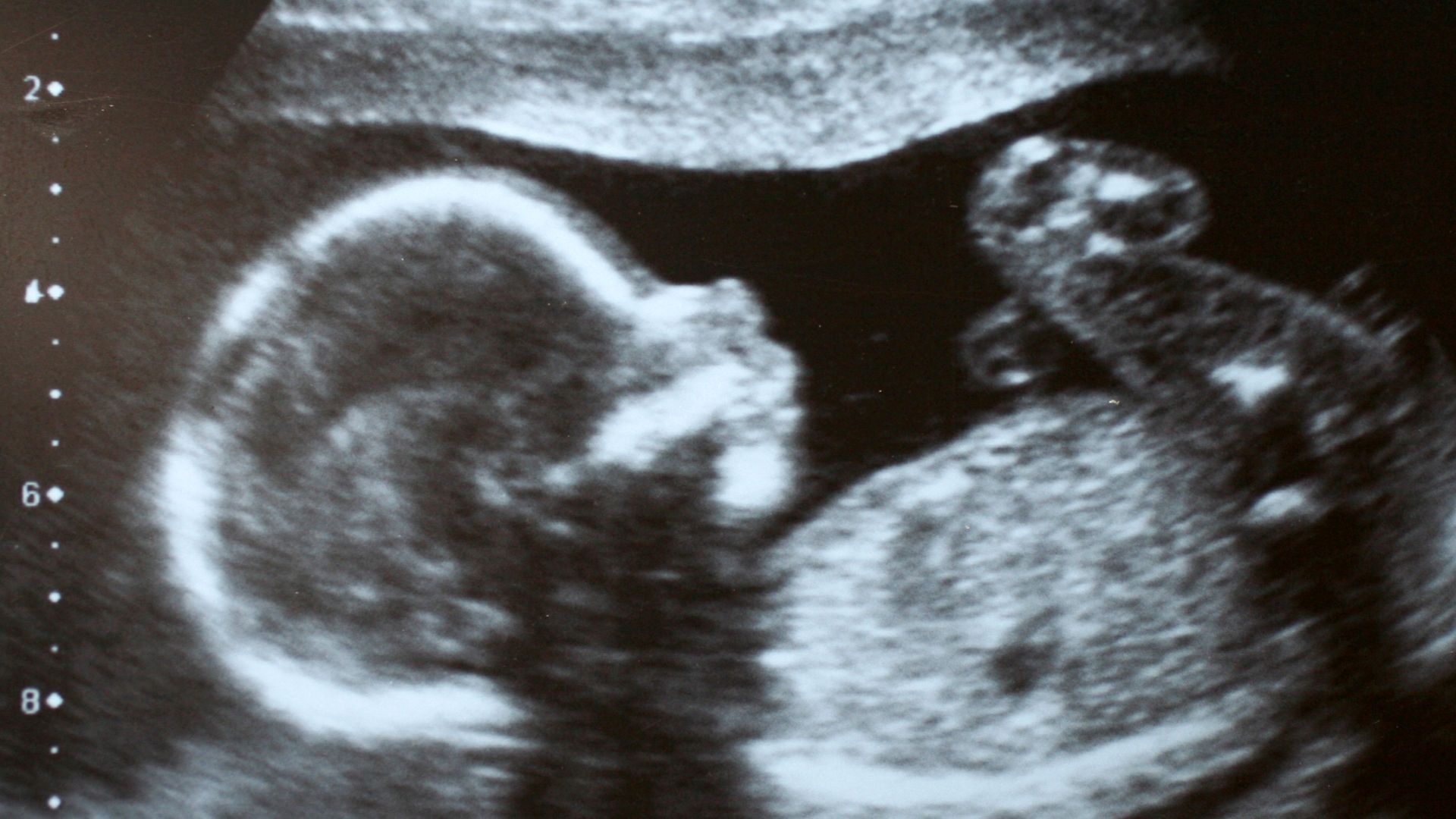 Inside UK’s maternity crisis: What it’s really like to give birth