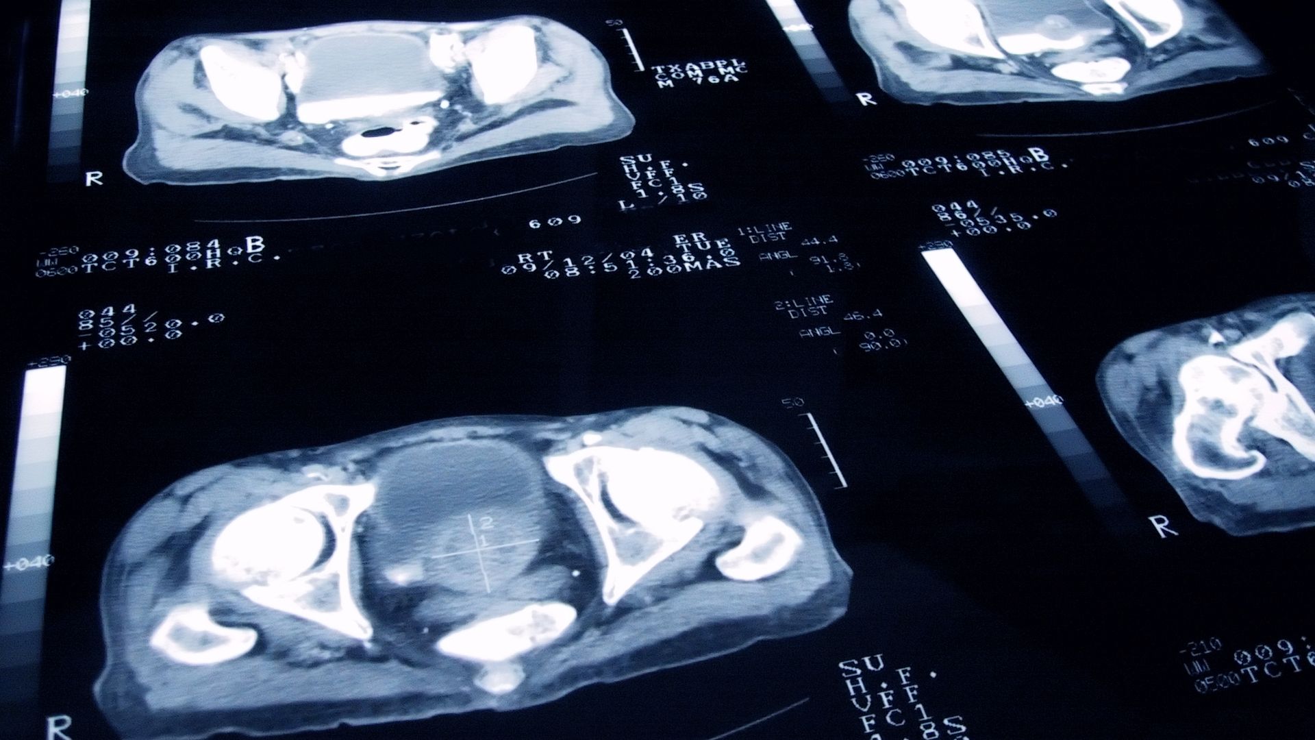 ‘Missed opportunity’ as government rejects call for mass prostate cancer screening