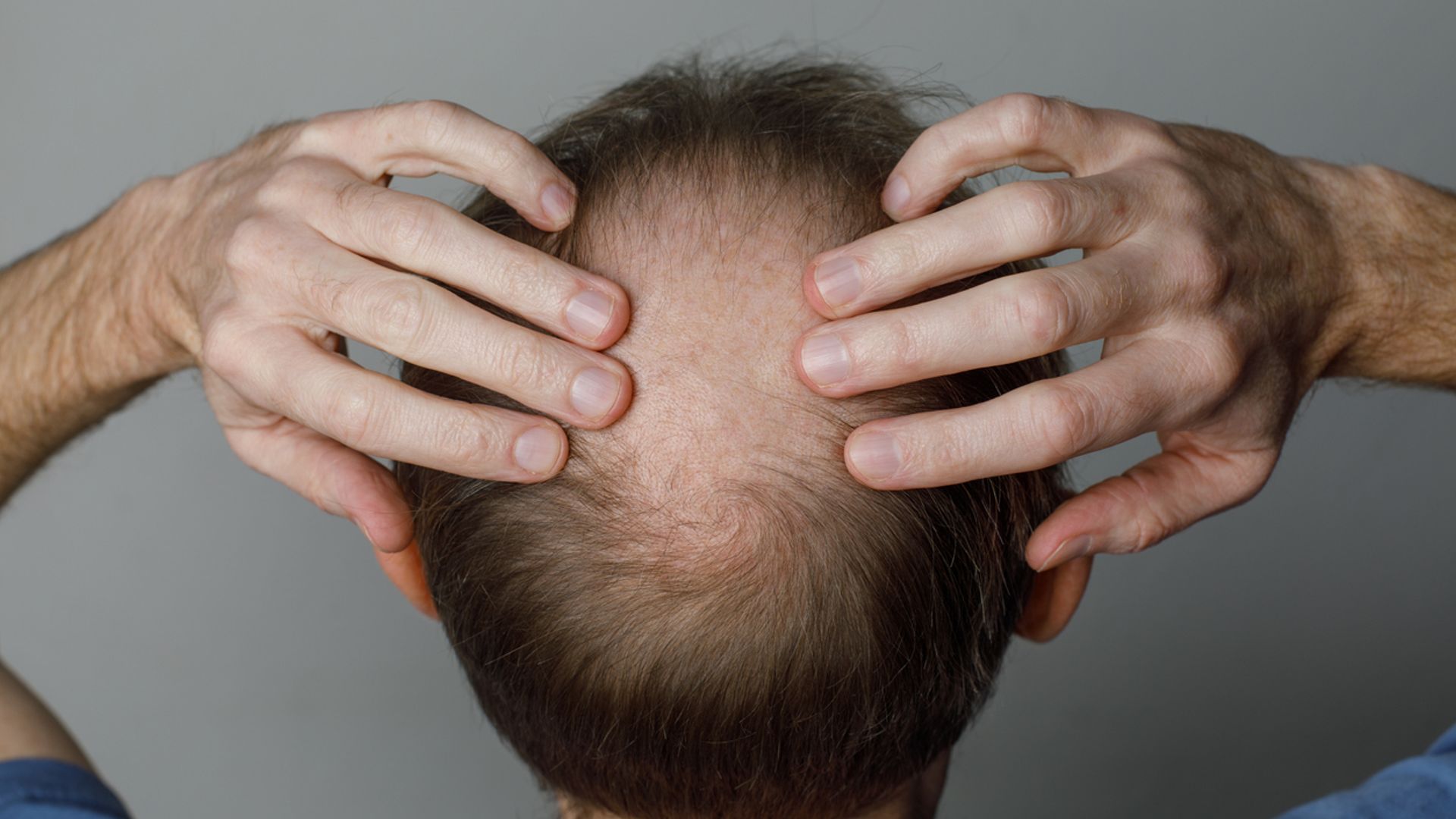 Weight loss drugs linked to increased risk of hair loss