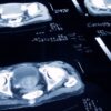 Vital clues could help predict prostate cancer years in advance
