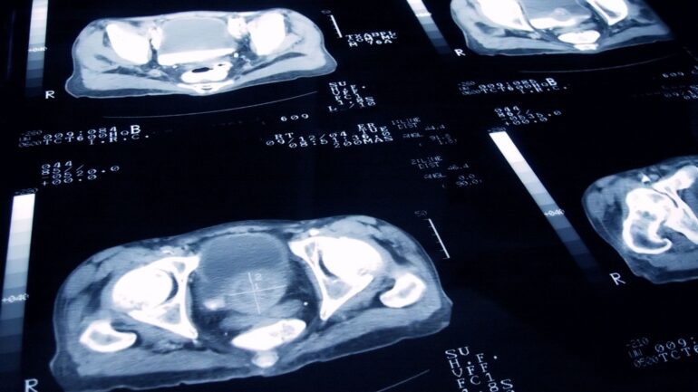 Vital clues could help predict prostate cancer years in advance